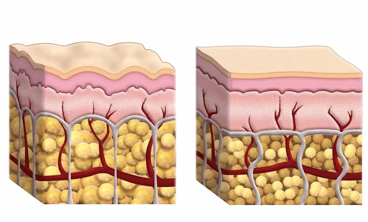 Fat cells during the use of Keto Guru